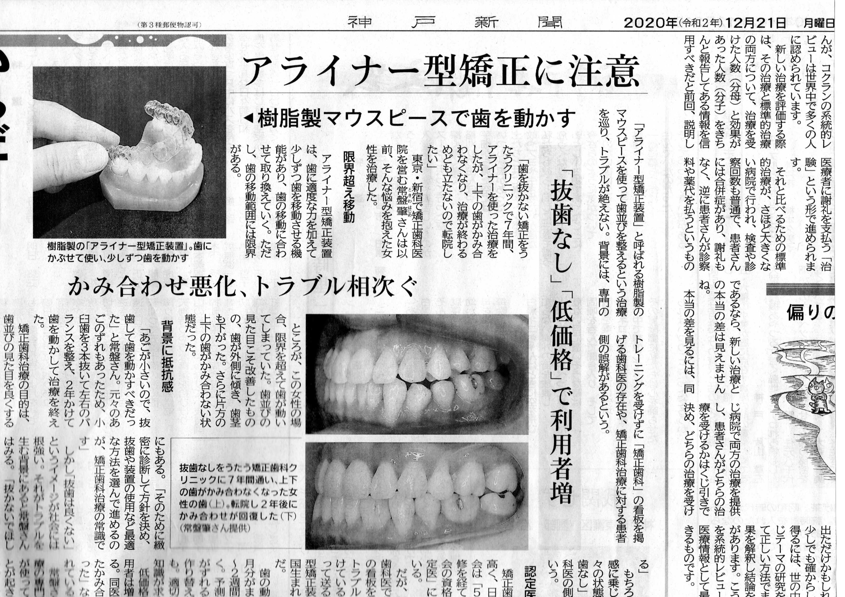 アライナー矯正に関する神戸新聞の記事について/姫路はま矯正歯科